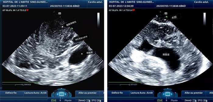 左圖顯示術(shù)中超聲見(jiàn)囊實(shí)性病變，大小約為4x4x3cm，病灶周圍腦組織水腫明顯；右圖為病灶切除后，術(shù)中超聲示術(shù)腔無(wú)病變殘留