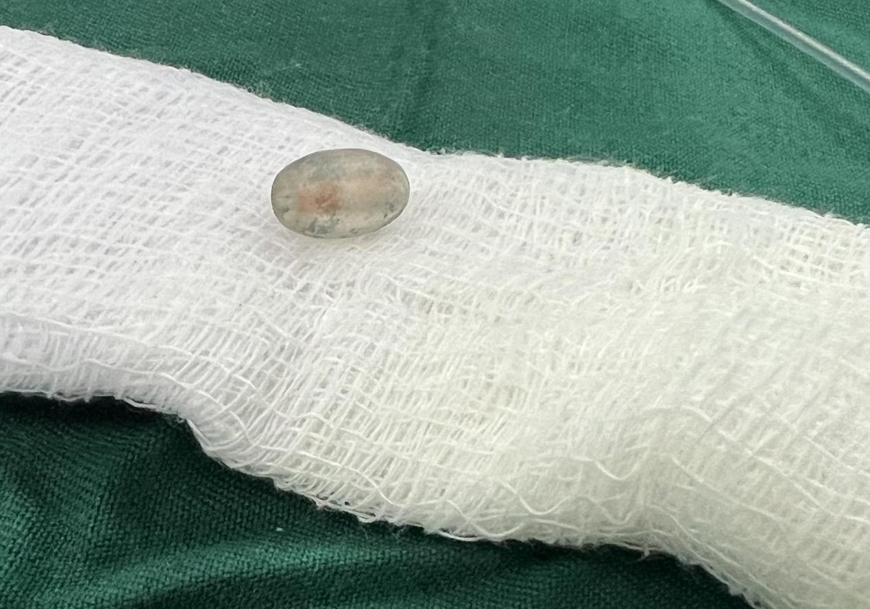 被取出的異物。中國援桑醫(yī)療隊(duì)供圖