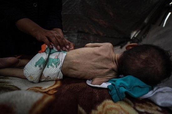 這是5月28日在加沙城西部一處臨時(shí)安置點(diǎn)拍攝的一名營養(yǎng)不良的嬰兒。新華社發(fā)（馬哈茂德·扎基攝）